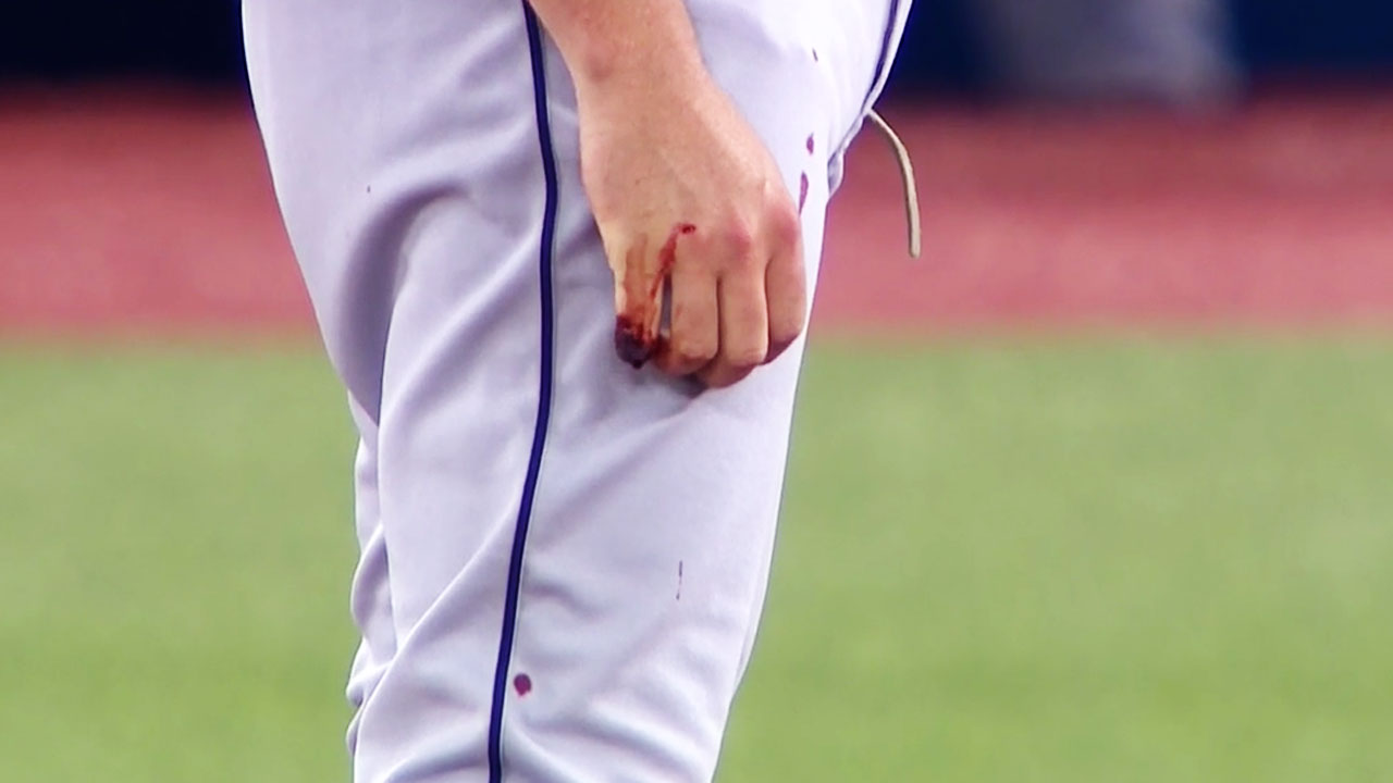 Trevor Bauer's finger was bleeding, and Justin Verlander told him