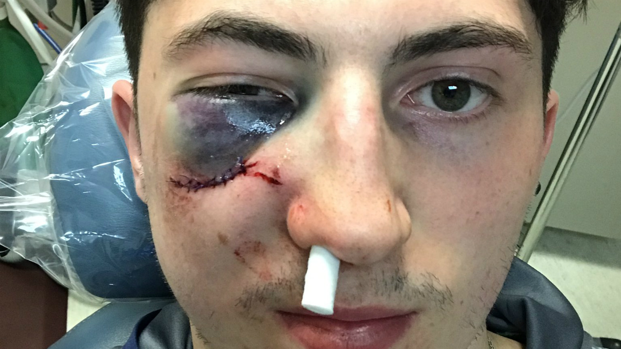 nhl puck to the face